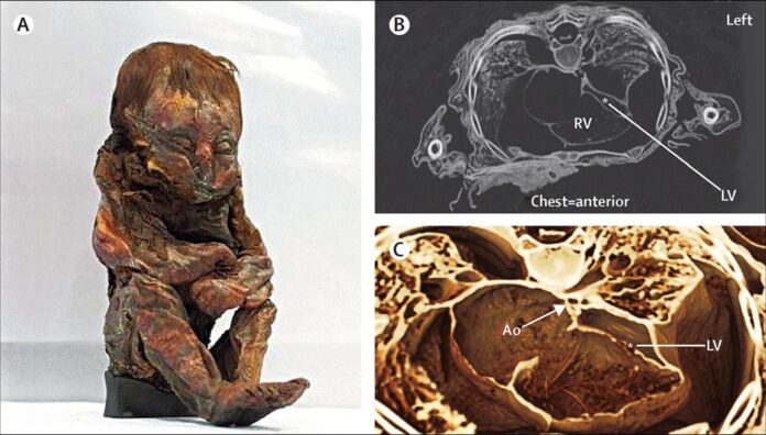 Ancient Medical Mystery Uncovered: 6,500-Year-Old Peruvian Mummy Reveals Groundbreaking Insights